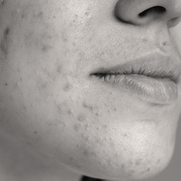 Pimple & Acne