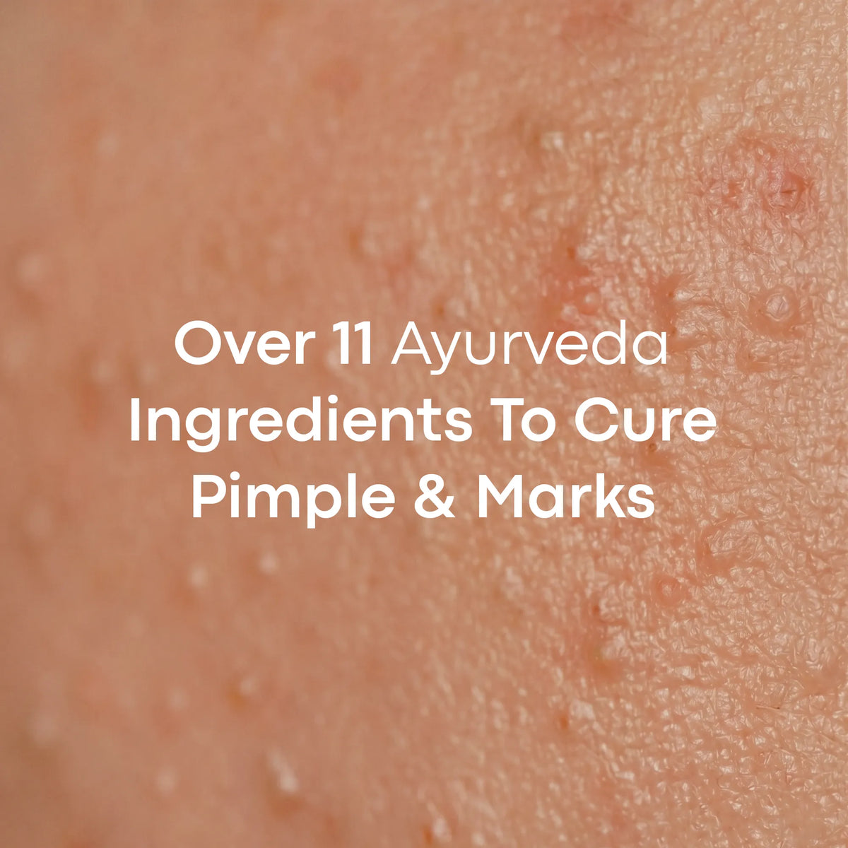 LAVAL Ayurveda Pimple Face Mask