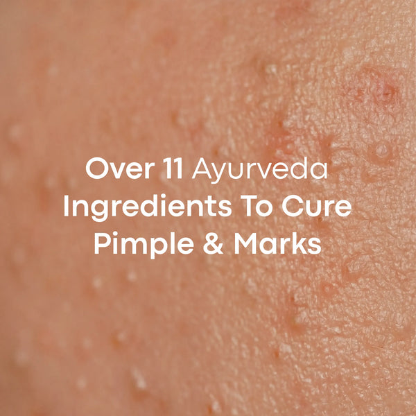 LAVAL Ayurveda Pimple Face Mask