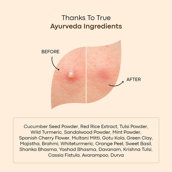 LAVAL Ayurveda Pimple Face Mask